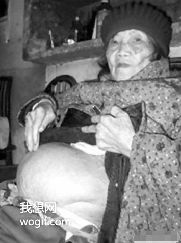 四川一91歲老奶奶不慎摔倒，到醫院后發現懷孕了（60年前懷上的）